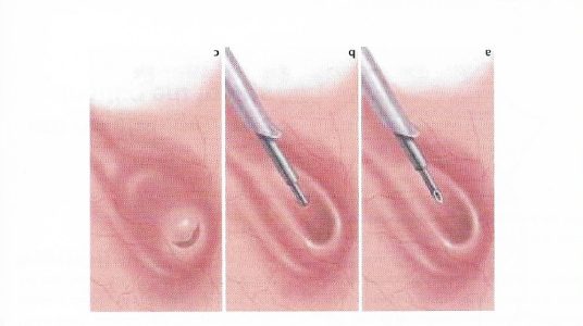 Κυστεοουρητηρική