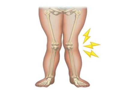 βλαισογονία