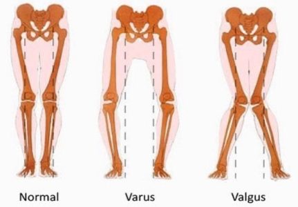 βλαισογονία