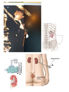 Διαδερμική