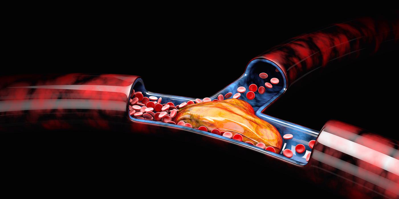 αρτηριοπάθεια